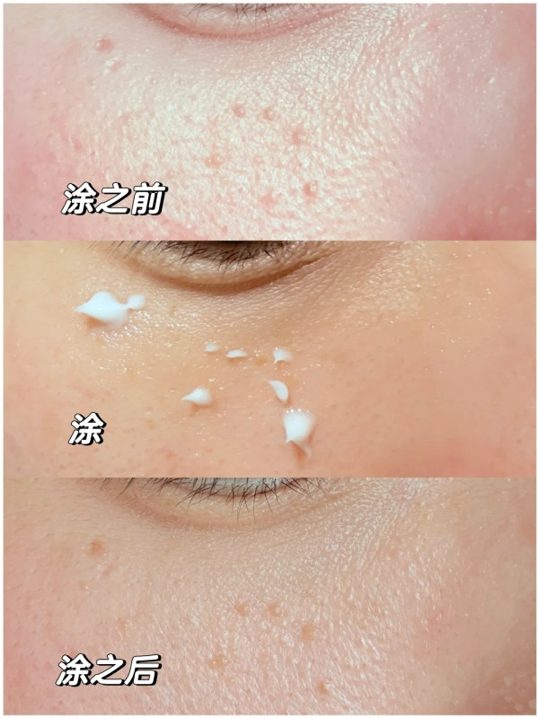 生油脂粒/肉芽救星！網民熱推必買韓國好物：幾日即平整﹑阿媽都讚好用