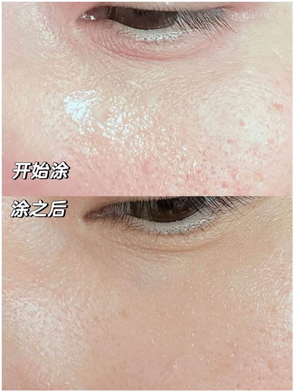 生油脂粒/肉芽救星！網民熱推必買韓國好物：幾日即平整﹑阿媽都讚好用