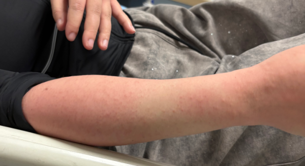 海鮮禁忌｜食完蝦去做Gym險送命！30歲女全身出疹兼「大脷」 醫生警告：食海鮮後6小時內千祈咪做呢件事！