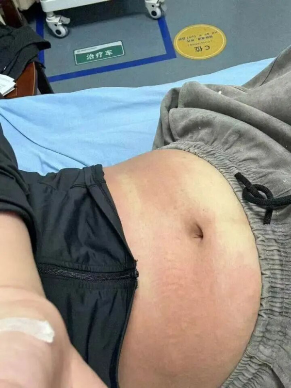 海鮮禁忌｜食完蝦去做Gym險送命！30歲女全身出疹兼「大脷」 醫生警告：食海鮮後6小時內千祈咪做呢件事！