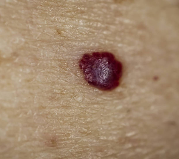 皮膚突然出現小紅點恐是癌症先兆!? 櫻桃血管瘤醫生籲2情況請即就醫