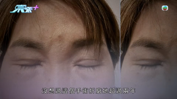 港女深圳醫美修復雙眼皮驚變噩夢！眼角夾出一物慘受折磨兩年 恐怖後果極駭人