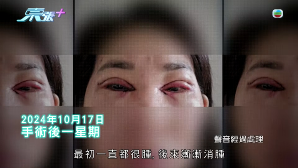 港女深圳醫美修復雙眼皮驚變噩夢！眼角夾出一物慘受折磨兩年 恐怖後果極駭人
