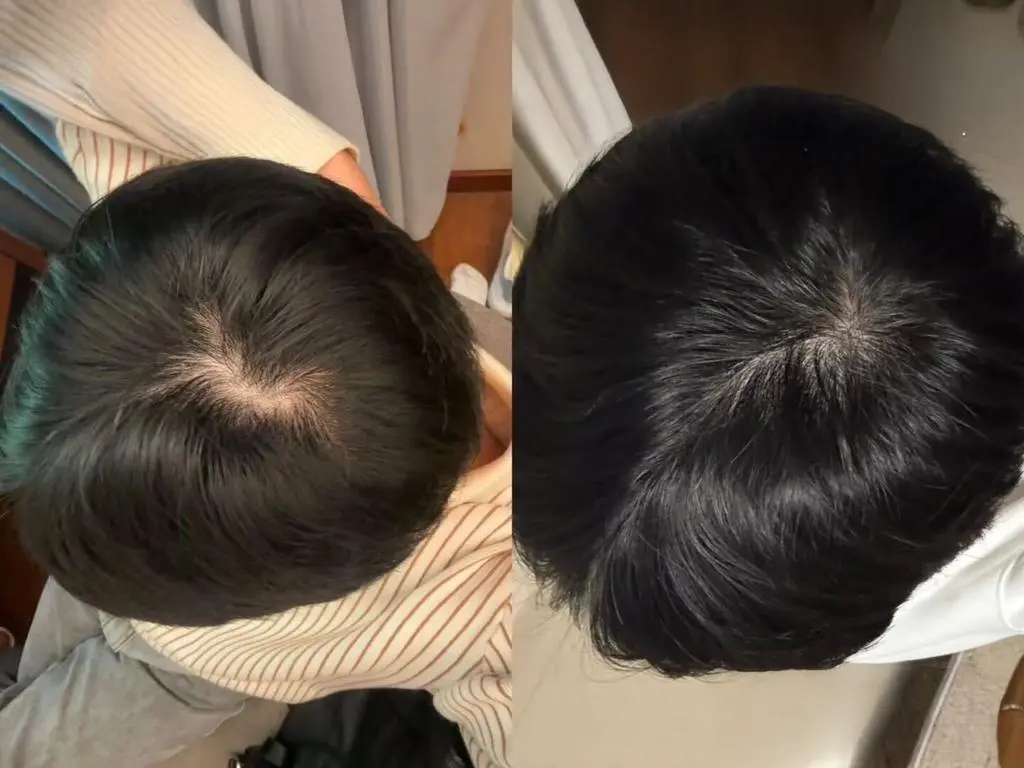 脫髮救星定智商稅?網民推韓國防脫精華拯救壓力禿:搽咗一排已經甩少咗好多