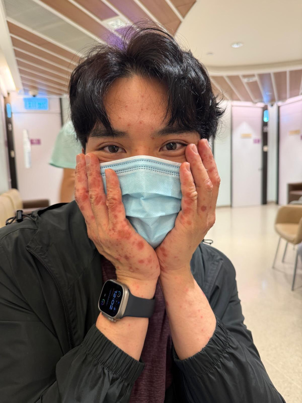 “风少”陈浚霆惊传意外严重过敏险毁容!欧游出事全身布满红斑留院5天