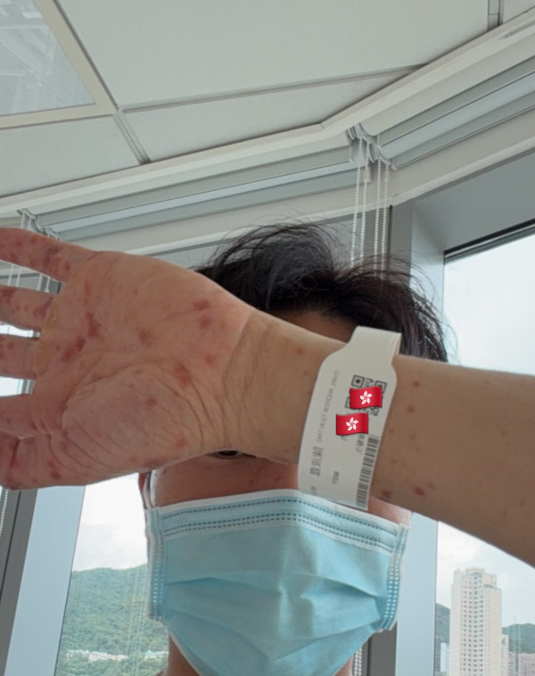 “风少”陈浚霆惊传意外严重过敏险毁容!欧游出事全身布满红斑留院5天