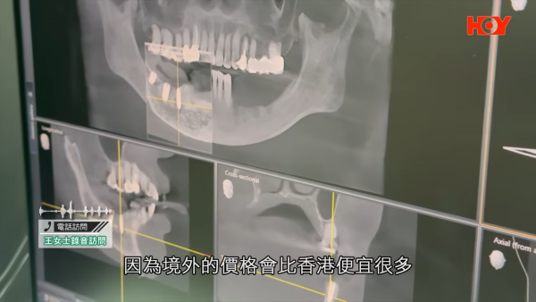 北上整牙最平$18起有交易?港女贪平深圳植牙失败致永久神经受损!牙医学会:过万港人返港“执手尾”