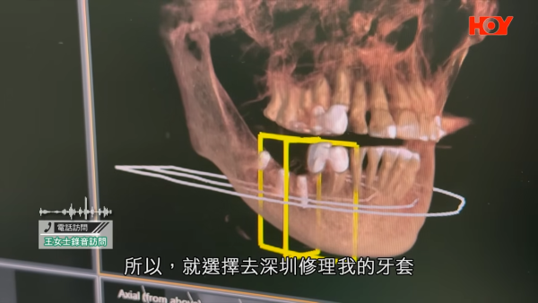 北上整牙最平$18起有交易?港女贪平深圳植牙失败致永久神经受损!牙医学会:过万港人返港“执手尾”
