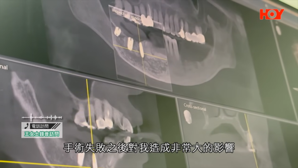 北上整牙最平$18起有交易?港女贪平深圳植牙失败致永久神经受损!牙医学会:过万港人返港“执手尾”