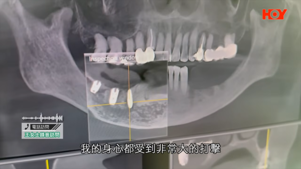 北上整牙最平$18起有交易?港女贪平深圳植牙失败致永久神经受损!牙医学会:过万港人返港“执手尾”
