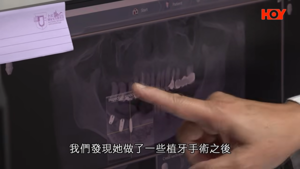 北上整牙最平$18起有交易?港女贪平深圳植牙失败致永久神经受损!牙医学会:过万港人返港“执手尾”