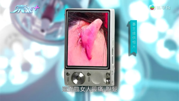 港女赴深圳拉皮惨变毁容级包包面!恐怖疤痕增生兼狂掉头发 涉假病历院长嚣张寸爆