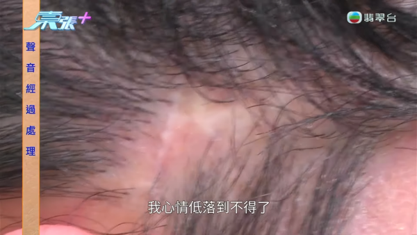 港女赴深圳拉皮惨变毁容级包包面！恐怖疤痕增生兼狂掉头发 涉假病历院长嚣张寸爆