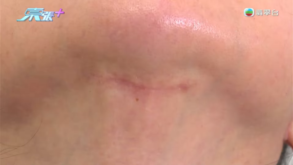 港女赴深圳拉皮惨变毁容级包包面！恐怖疤痕增生兼狂掉头发 涉假病历院长嚣张寸爆