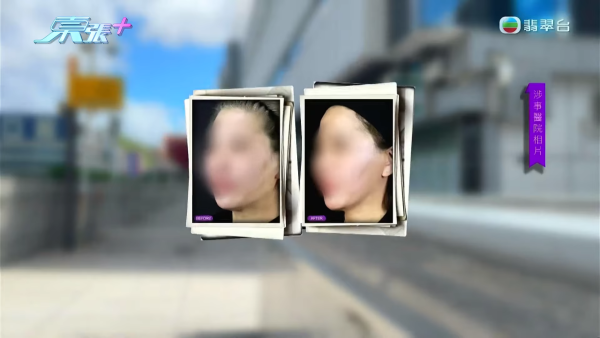 港女赴深圳拉皮惨变毁容级包包面！恐怖疤痕增生兼狂掉头发 涉假病历院长嚣张寸爆