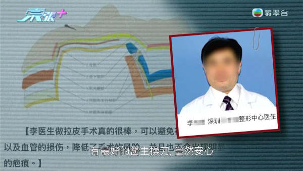 港女赴深圳拉皮惨变毁容级包包面!恐怖疤痕增生兼狂掉头发 涉假病历院长嚣张寸爆