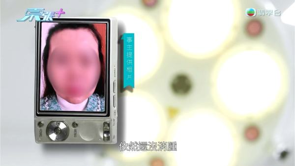 港女赴深圳拉皮惨变毁容级包包面!恐怖疤痕增生兼狂掉头发 涉假病历院长嚣张寸爆