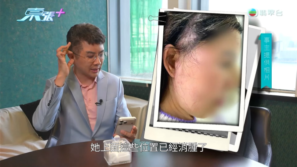港女赴深圳拉皮惨变毁容级包包面!恐怖疤痕增生兼狂掉头发 涉假病历院长嚣张寸爆