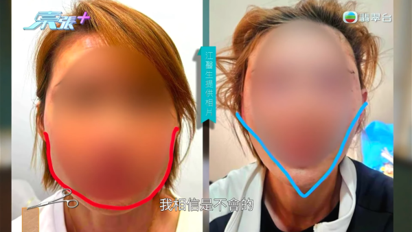 港女赴深圳拉皮惨变毁容级包包面!恐怖疤痕增生兼狂掉头发 涉假病历院长嚣张寸爆