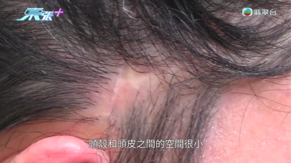 港女赴深圳拉皮惨变毁容级包包面！恐怖疤痕增生兼狂掉头发 涉假病历院长嚣张寸爆