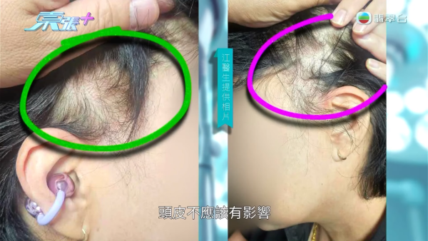 港女赴深圳拉皮惨变毁容级包包面！恐怖疤痕增生兼狂掉头发 涉假病历院长嚣张寸爆