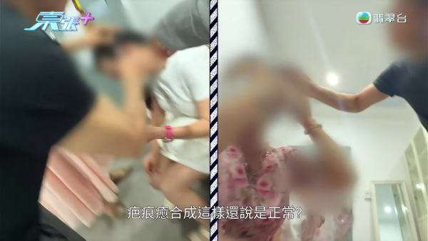 港女赴深圳拉皮惨变毁容级包包面！恐怖疤痕增生兼狂掉头发 涉假病历院长嚣张寸爆