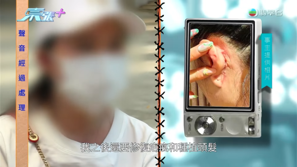 港女赴深圳拉皮惨变毁容级包包面!恐怖疤痕增生兼狂掉头发 涉假病历院长嚣张寸爆