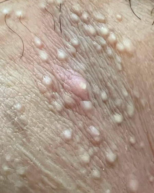 健康熱話｜私密處生黃白顆粒以為染性病！狂擠爆血求醫 醫生揭真相勸勿做1事