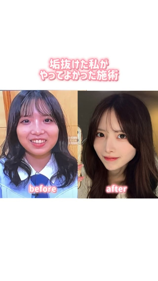 日本女團成員自爆花600萬日圓整容 吐露偶像時期自卑心聲:「以為自己太醜才沒人氣」