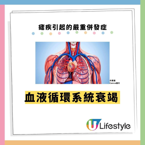 机场爆发罕见疟疾2死!毒蚊客舱偷渡入境 揭5大高危病征+6招防蚊方法