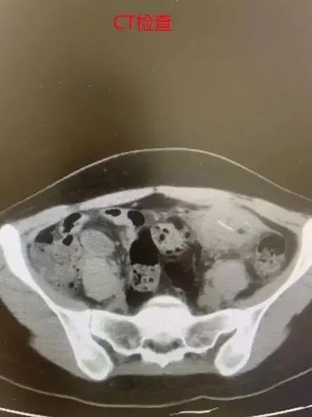 邊食飯邊睇手機險死！內地女腸臟被刺穿發燒送院！醫生揭原因竟與筷子有關 附自救指南 