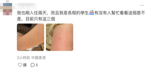 沙田酒店疑爆床蝨！孕婦花3.7萬長租咬到起水泡 經理稱過敏事主求診證蝨咬