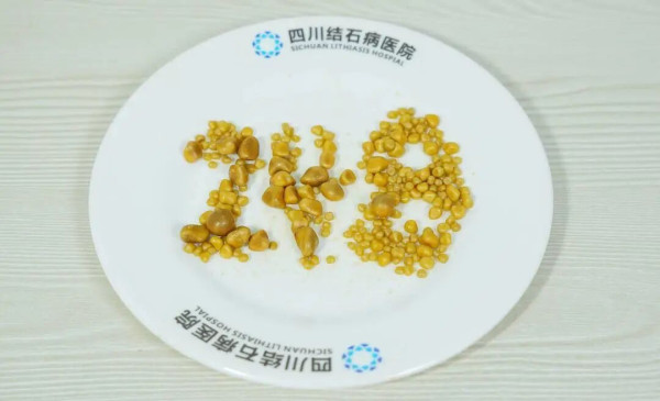 26歲打工仔生248粒膽結石！劇痛送院膽囊被塞爆／醫嘆1飲食惡習血脂超標逾5倍