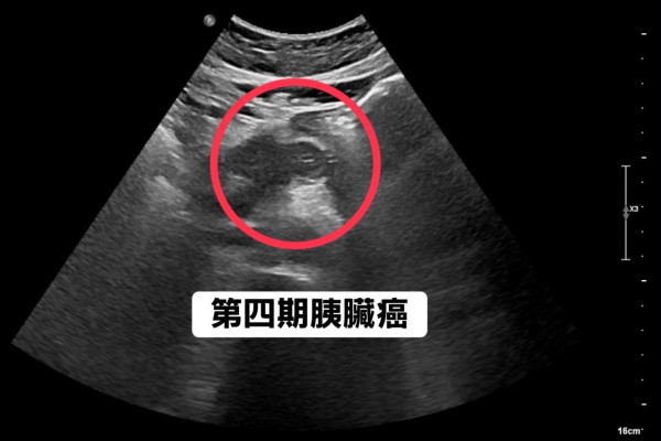 圖片來源：Facebook@胰臟醫師 林相宏 禾馨民權內科診所