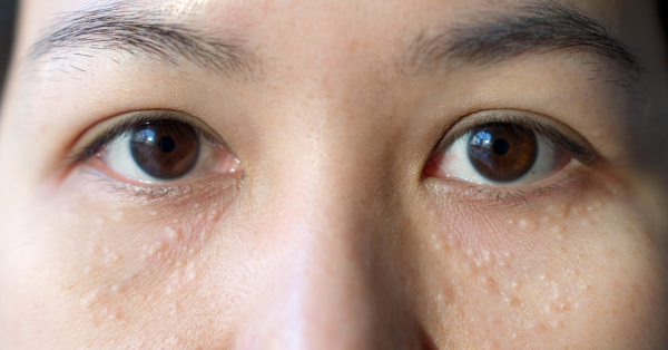 乱滴日本眼药水恐失明?专家揭恐怖副作用 随时诱发青光眼视网膜剥离