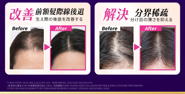 頭髮愈來愈薄？你都有脫髮煩惱？「升級版Return醫學級生髮配方」深入毛囊育髮再生