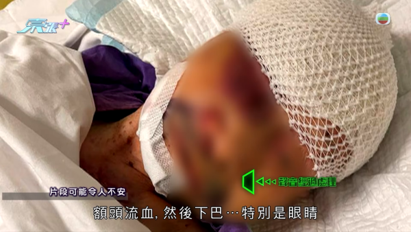 长期卧床不可能跌倒！慈云山养老院百岁老妇重伤缝9针！惊揭同房院友伤人恐怖悲剧