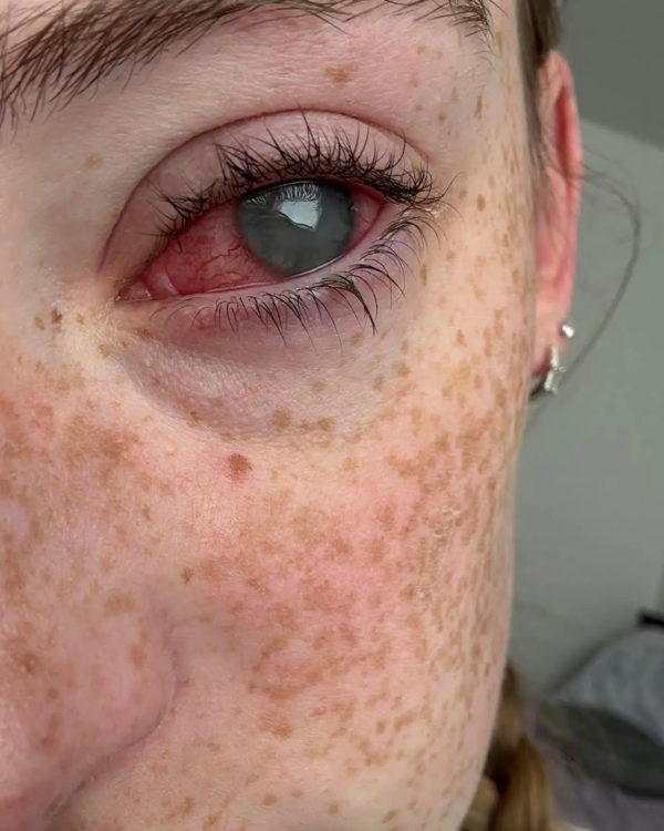 戴隱形眼鏡沖涼出事!美國20歲女感染食腦阿米巴變形蟲 雙眼一度失明一年未康復