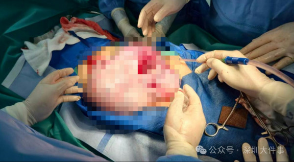 11歲女以為發育肥竟是生4kg畸胎瘤！學校跑步突劇痛送院開刀／醫生籲4大警號