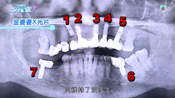 柴灣街坊集體指控牙醫醫療失當!15萬植牙慘變「大海撈針」 4.5萬全口箍牙竟越箍越疏