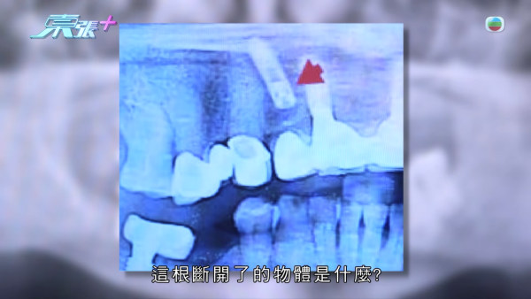 柴灣街坊集體指控牙醫醫療失當！15萬植牙慘變「大海撈針」 4.5萬全口箍牙竟越箍越疏 