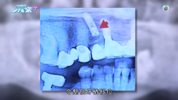 柴灣街坊集體指控牙醫醫療失當！15萬植牙慘變「大海撈針」 4.5萬全口箍牙竟越箍越疏 