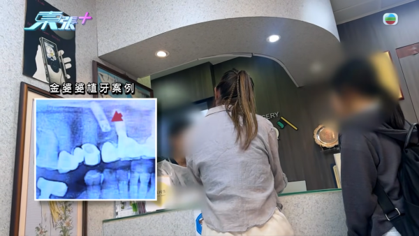 柴灣街坊集體指控牙醫醫療失當!15萬植牙慘變「大海撈針」 4.5萬全口箍牙竟越箍越疏