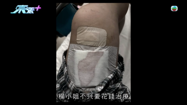 元朗村屋惡犬撕咬恐怖慘劇苦主現身 手指縫6針變形 患創傷後遺症長期於青山醫院覆診