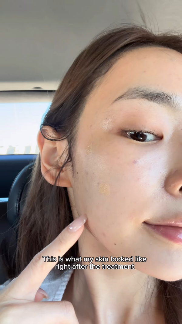 陈桢怡震撼公开韩国医美过程，曝光真面目！素颜惊现欧式双眼皮与丰唇神奇进化
