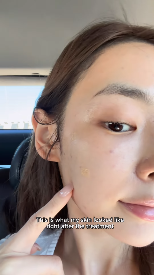 陈桢怡震撼公开韩国医美过程，曝光真面目！素颜惊现欧式双眼皮与丰唇神奇进化