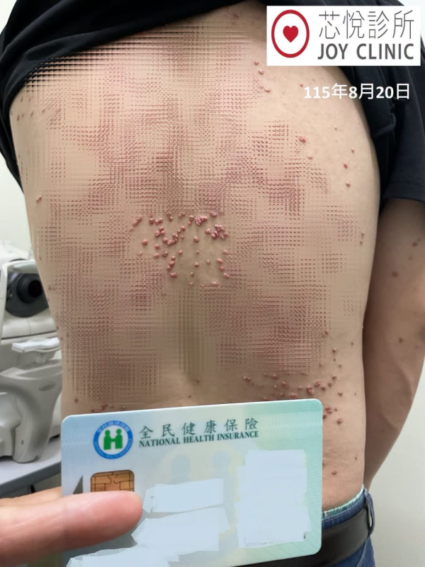 23歲男血糖失控背生過百粒黃紅色瘤！恐怖過梅毒曾3度患胰臟炎／醫：致死率極高