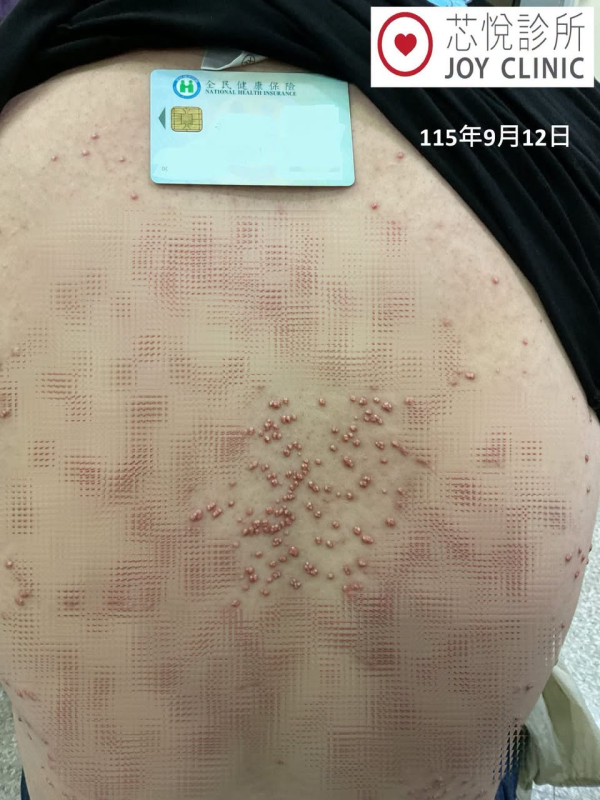23歲男血糖失控背生過百粒黃紅色瘤！恐怖過梅毒曾3度患胰臟炎／醫：致死率極高