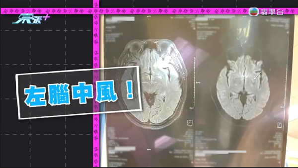 港女試做$268美容療程慘變左腦中風！疑遭按摩師拉扯肩頸致血管撕裂 身體抽搐麻痹入院