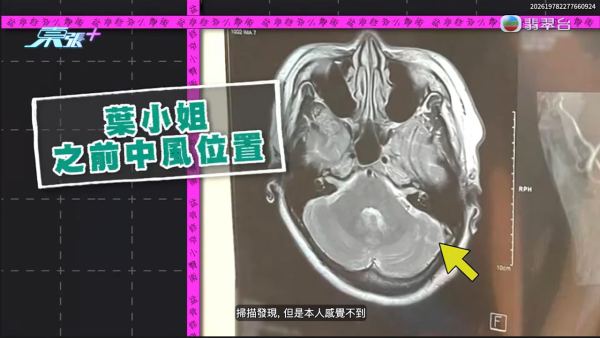 港女試做$268美容療程慘變左腦中風！疑遭按摩師拉扯肩頸致血管撕裂 身體抽搐麻痹入院
